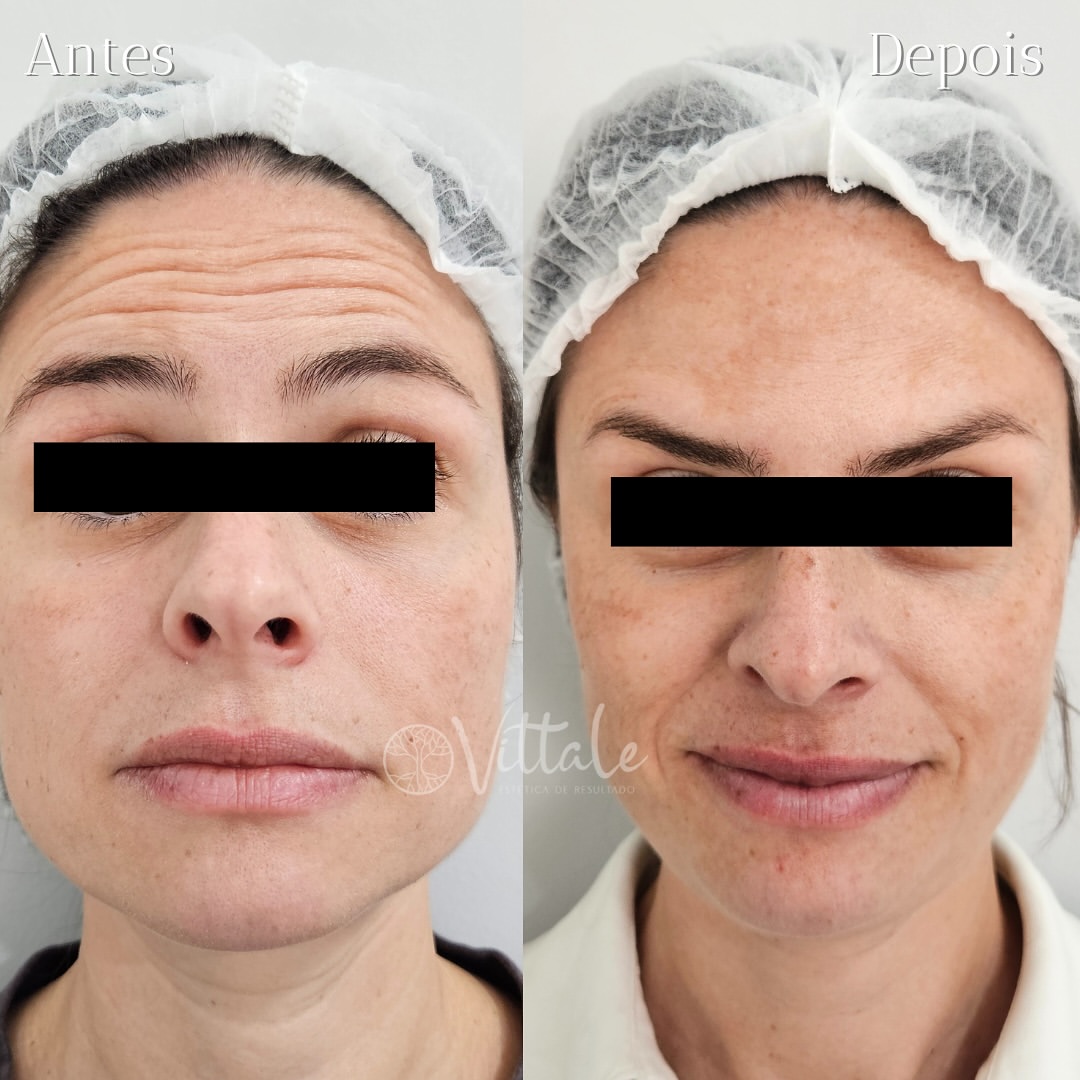 Antes e depois de Botox na Vittale Estética