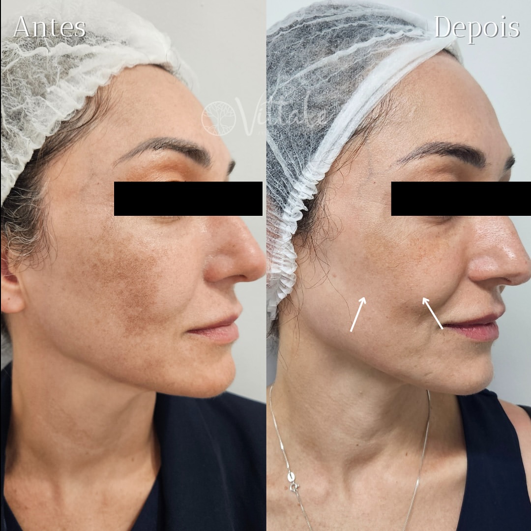 Antes e depois de tratamento de melasma com Lavieen na Vittale Estética